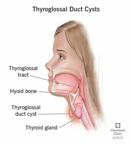 22351 thyroglossal duct cysts