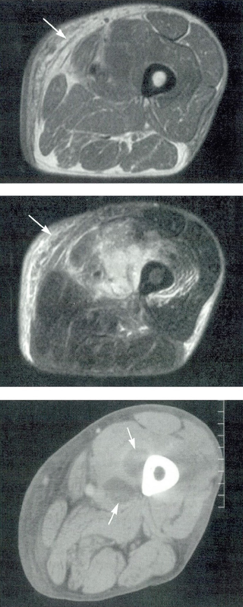 MRI-pildid (kaks ülemist pilti) näitavad põletikku reiekoes.  CT-skaneerimine (alumine pilt) näitab abstsessi (püomüosiiti), mis tekkis reieluu (reieluu) lähedal.
