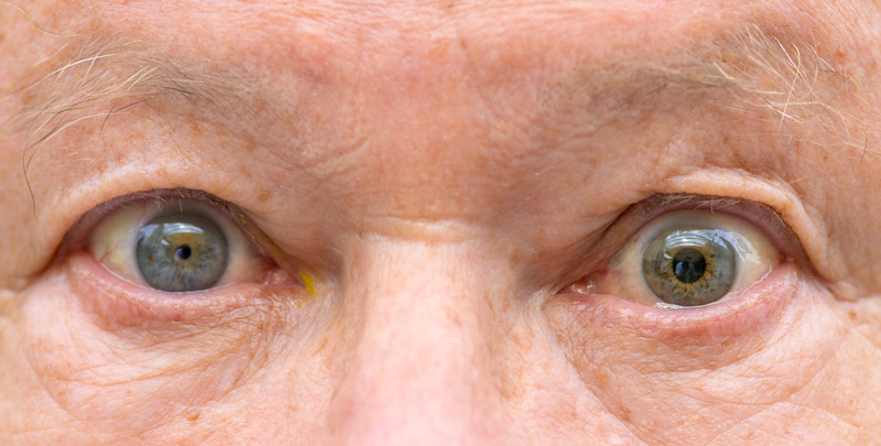 Anisokoria muudab pupillid ebakorrapärase suurusega.