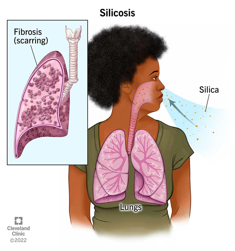 Ränidioksiidi (ränidioksiidi) osakeste sissehingamine põhjustab silikoosihaigete kopsudes armistumist (fibroosi).