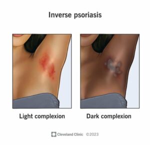 22852 inverse psoriasis