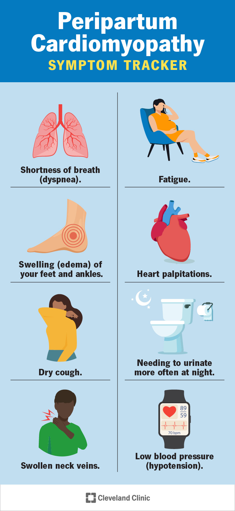 Sünnitusjärgse kardiomüopaatia sümptomiteks on väsimus, südamepekslemine ja õhupuudus.