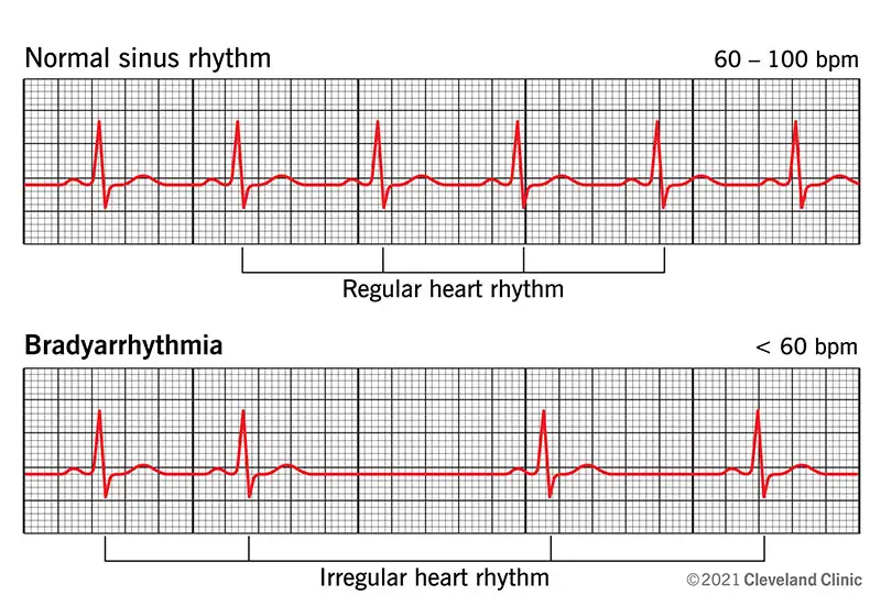 Bradüarütmia ja normaalse siinusrütmi võrdlus EKG-s.