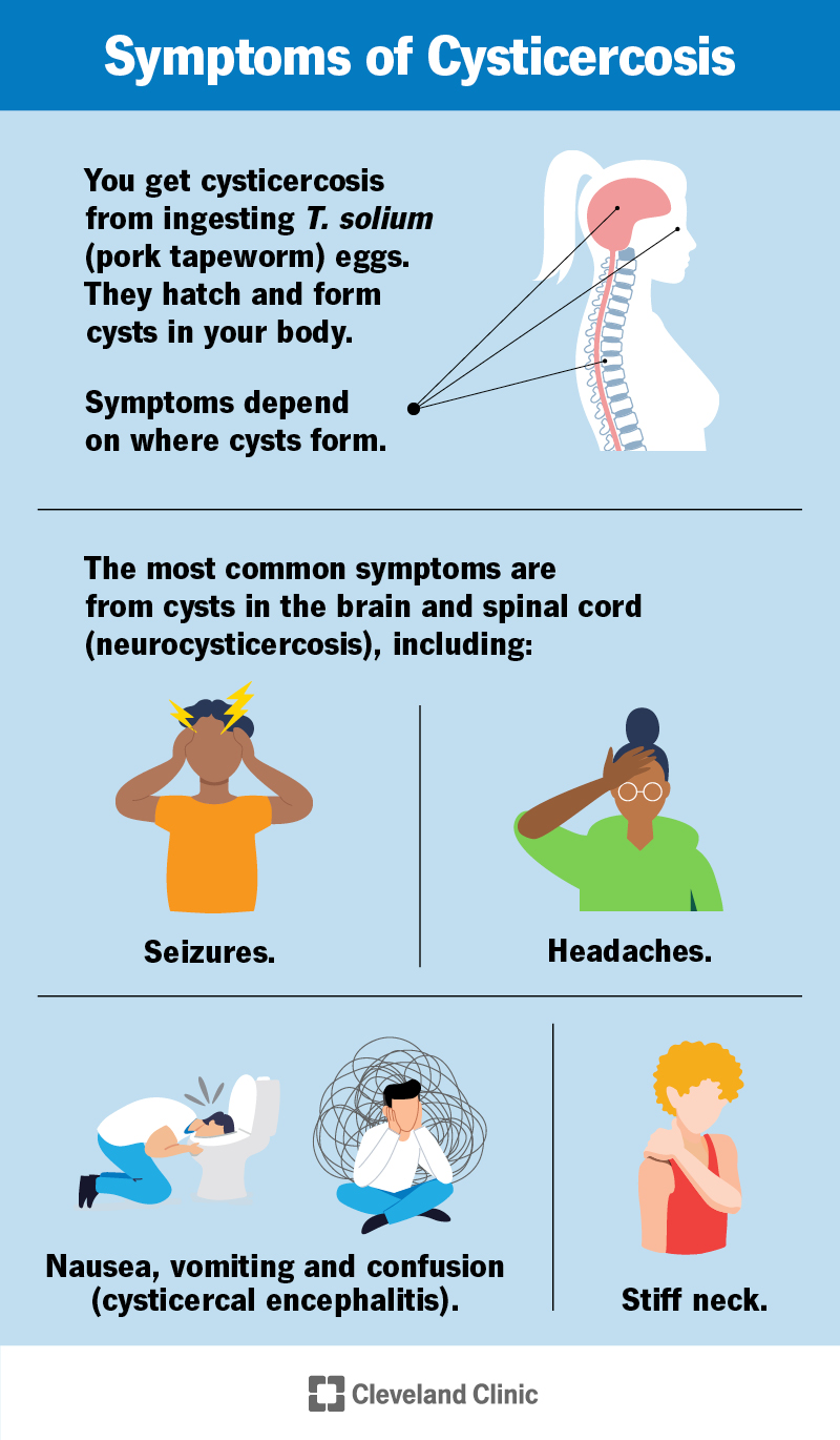 Tsüstitserkoosi tavalised sümptomid on krambid, peavalud, kaelakangus, oksendamine ja segasus, kuid need sõltuvad tsüstide asukohast.