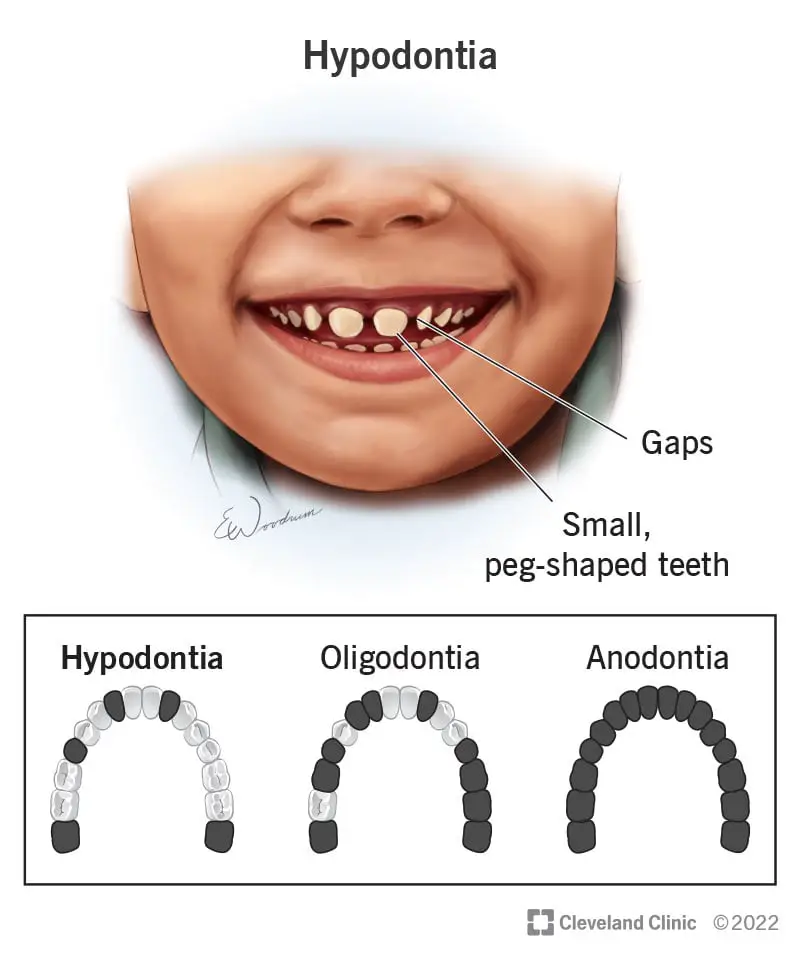 24192 hypodontia