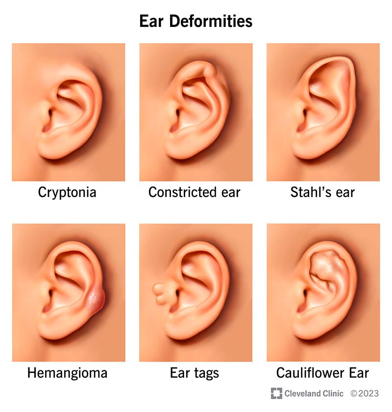 Pildid kõrvade deformatsioonidest: krüptoonia, kokkutõmbunud kõrv, Stahli kõrv, hemangioom, lisatragus ja lillkapsakõrv.