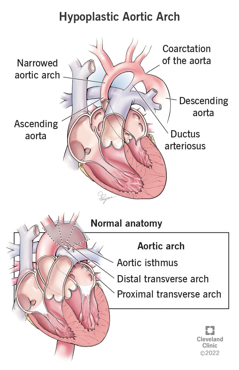 Aordi koarktatsioon koos aordikaare hüpoplaasia ja normaalse aordikaare anatoomiaga.