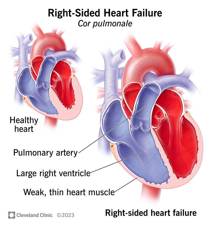 Cor pulmonale süda võrreldes tavalise südamega