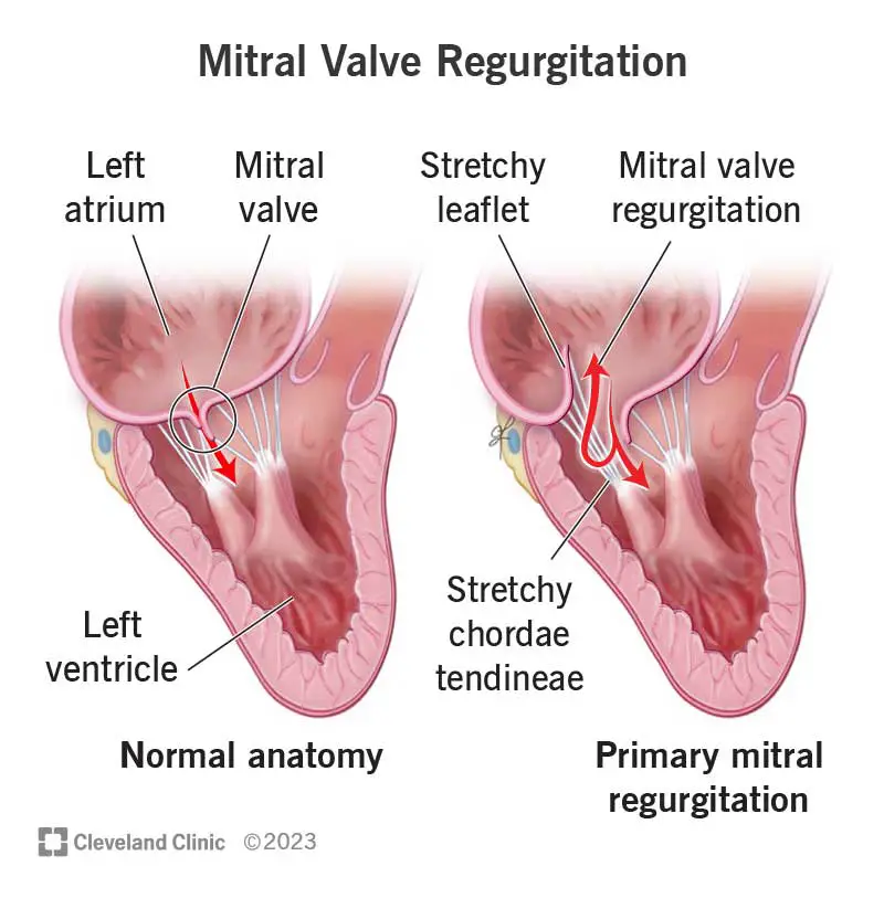 24983 mitral valve