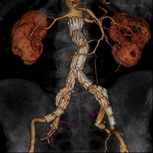 Kõhu aordi aneurüsmi stent