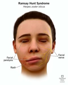 6093 ramsay hunt syndrome