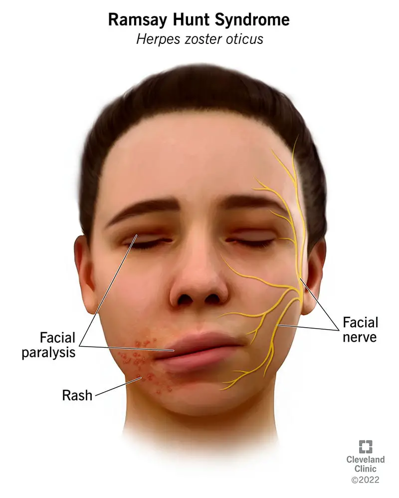 6093 ramsay hunt syndrome