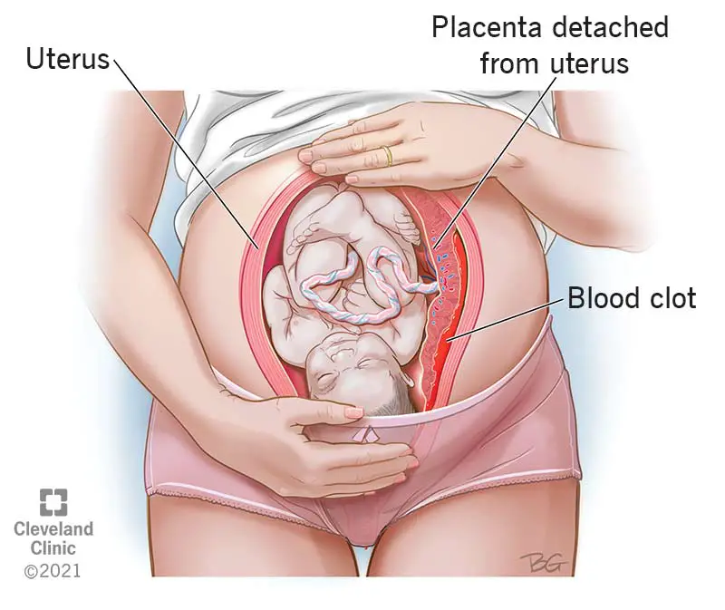 9435 placental abruption