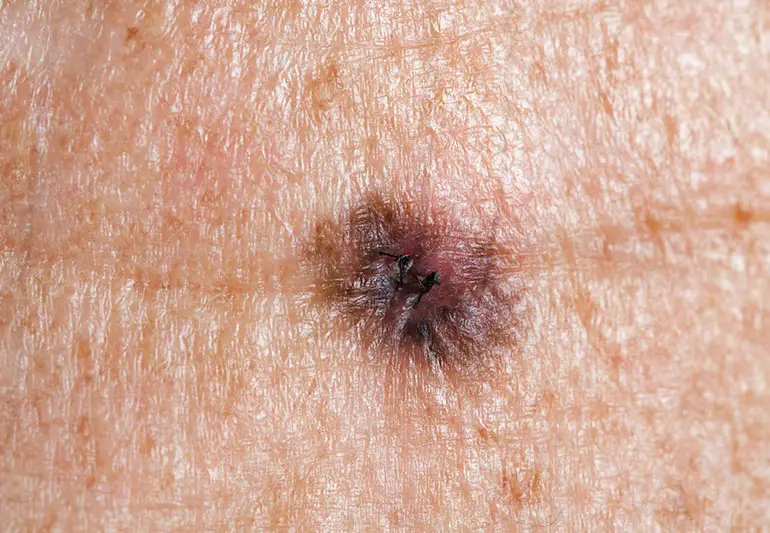 Melanoma 155131938770x533 1