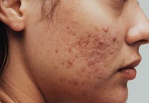 acne on face 1326434308 770x533 1