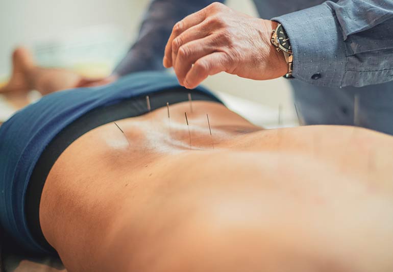 acupuncture Back 1251543001 770x533 1