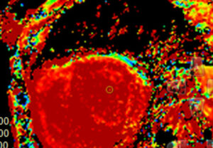 cardiacAmydorosis HVI medscape 770x553