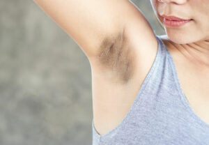 dark armpit 1181829080 770x533 1