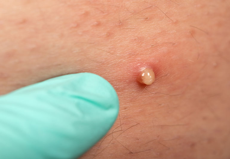 ingrown hair follicle butt 1289667581 770x533 1