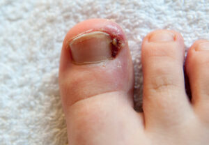 ingrownToenail 1165595353 770x553