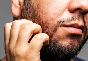 itchy beard 1136462491 770x533 1