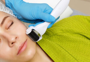 microneedling 699873274 770x533 1