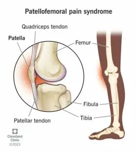 patellofemoral pain syndrome