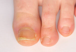 psoriaticArthritisToenails 1186515106 770x533 1