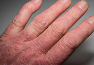 psoriaticRheumatoidArthritis1 182657432 770x533 1