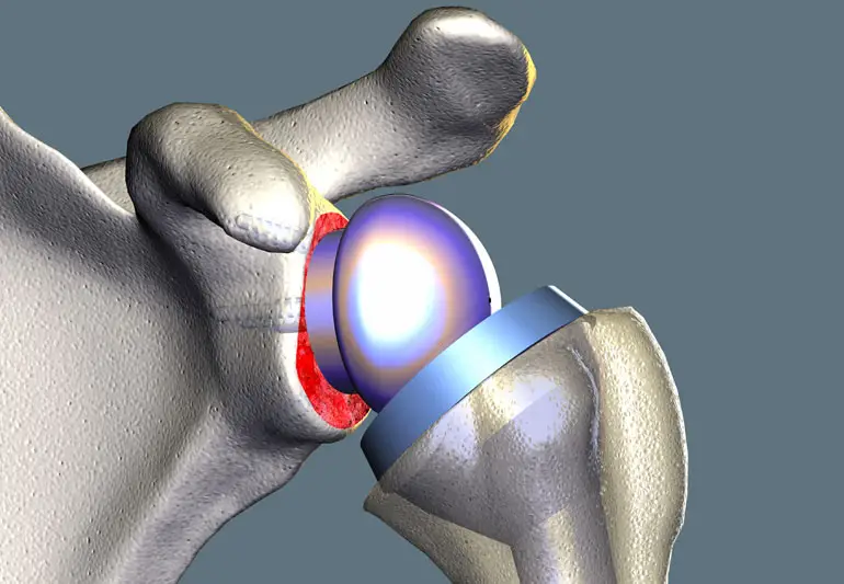 revShoulderReplacmnt SzaboIlust