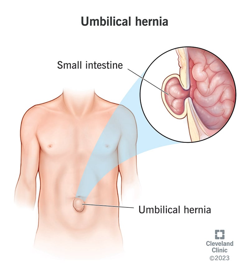 umbilical hernia