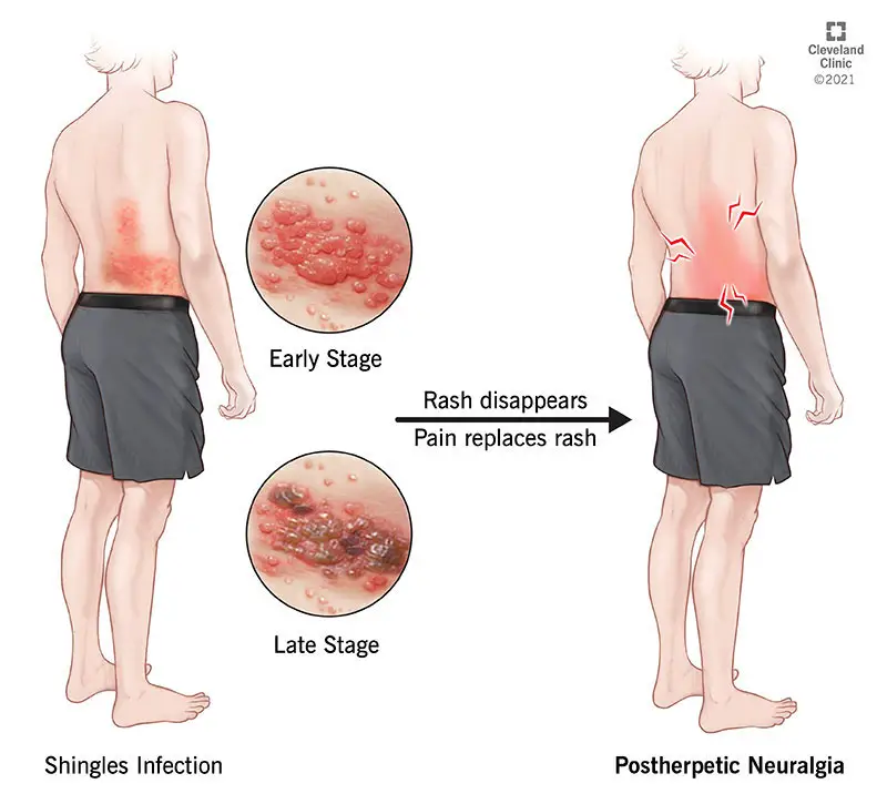 Postherpeetiline neuralgia