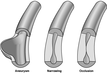 13284 polyarteritis nodosa