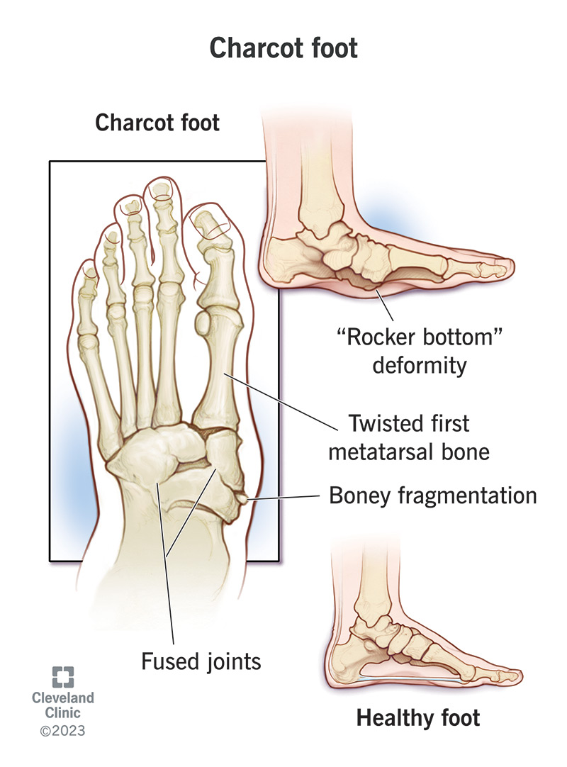 Charcoti jalg võib põhjustada tõsiseid tüsistusi, kui seda kohe ei ravita.