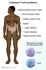 1706757566 17940 cutaneous t cell lymphoma