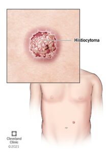 1706796331 23059 histiocytoma