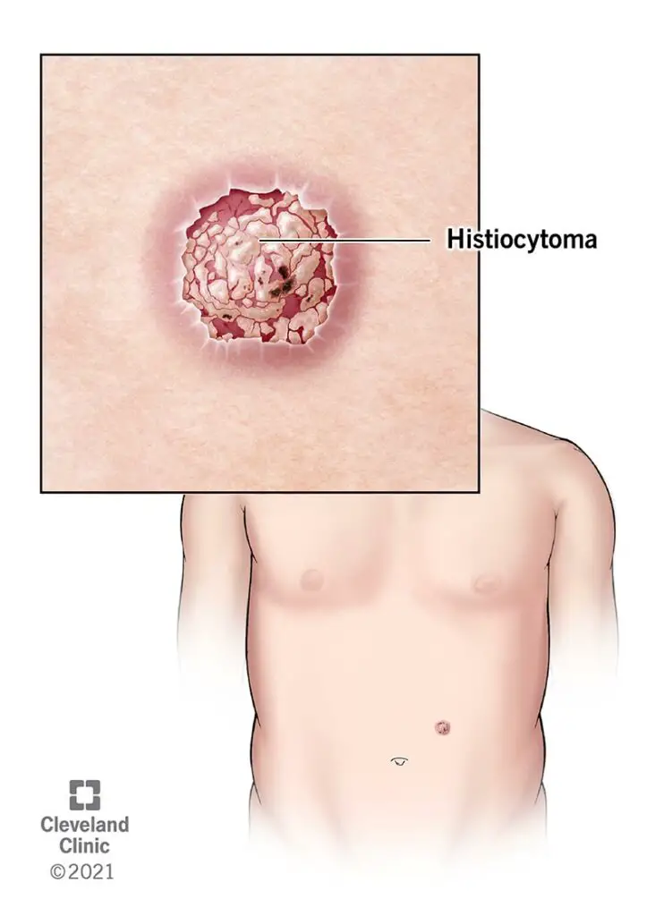 1706796331 23059 histiocytoma