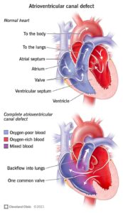 1706811686 22173 atrioventricular canal defect illustration