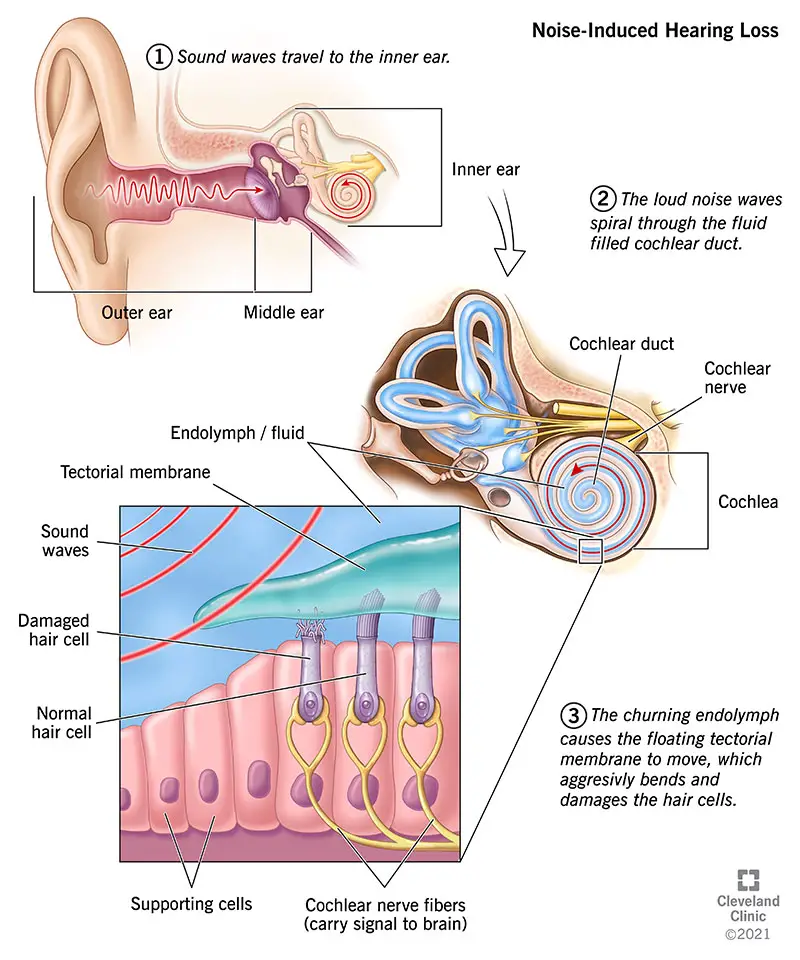 1706842460 21776 noise induced hearing loss