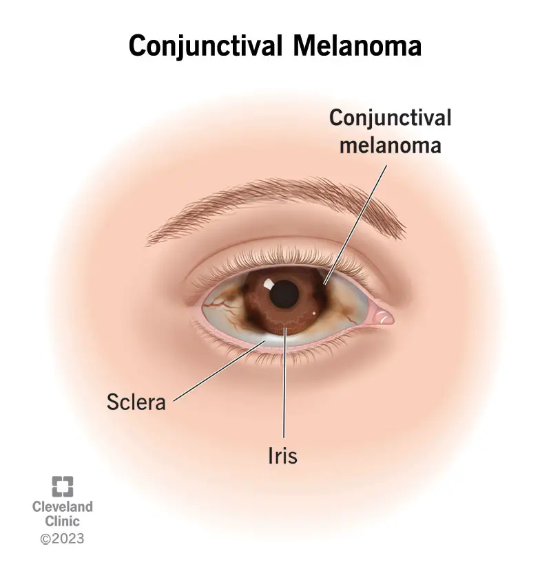 1706853981 24895 conjunctival melanoma