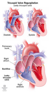 1706869584 21627 tricusp valve regurgitation illustration