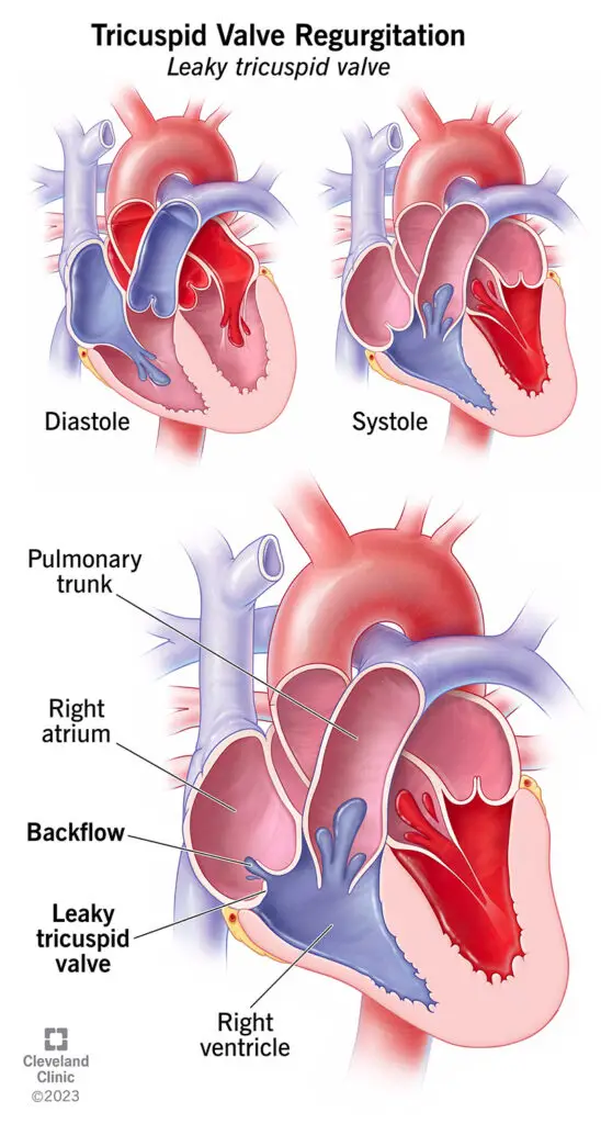 1706869584 21627 tricusp valve regurgitation illustration