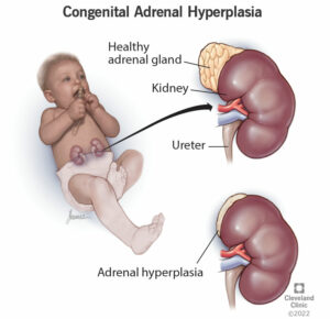 1706888778 17817 congentital adrenal hyperplasia