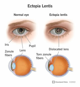 1706927174 24551 ectopia lentis