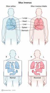 1706961859 23486 situs inversus