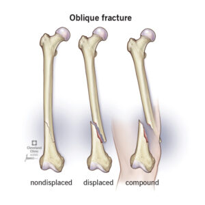 1706969539 22185 oblique fracture