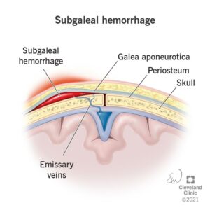 1707015863 22219 subgaleal hemorrhage