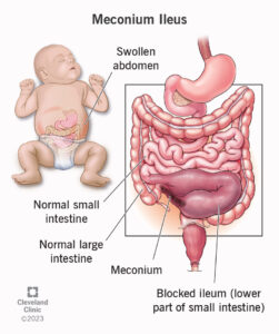 1707104299 22448 meconium ileus