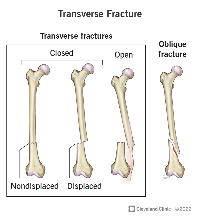 1707169881 22956 transverse fracture