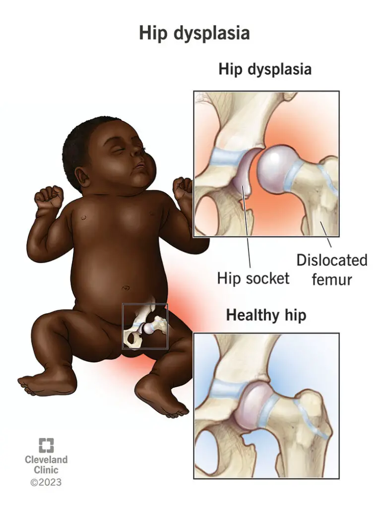 1707227599 17903 hip dysplasia 2